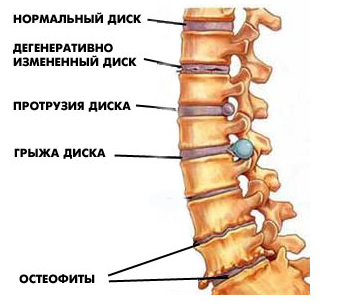 Остехондроз на модели позвоночника